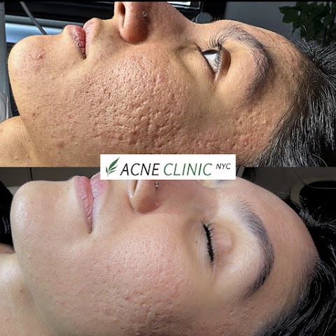 Acne Clinic NYC: Acne & Scars Treatment