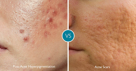Alinea Medical Spa Acne Scar & Laser Skin Care NYC