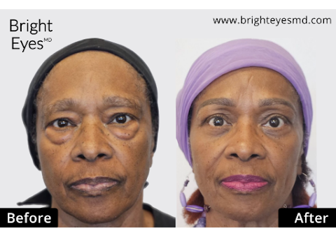 Bright Eyes MD