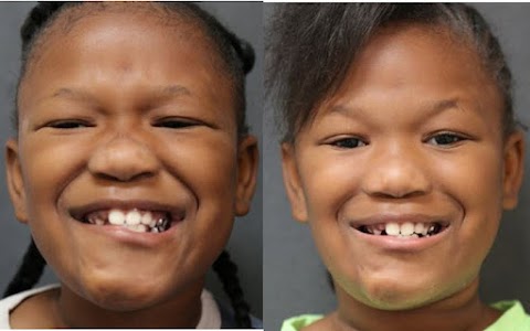New York Facial Paralysis