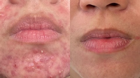 Clear Skin Solutions