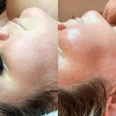 Devon Michelle Skin Studio ✨ Hydrodermabrasion Facial, Acne Treatment, Dermaplaning, Fire & Ice Facial