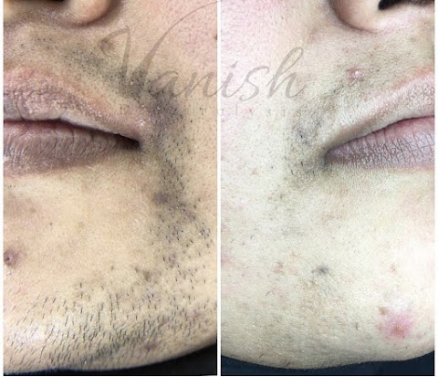 Vanish Electrolysis