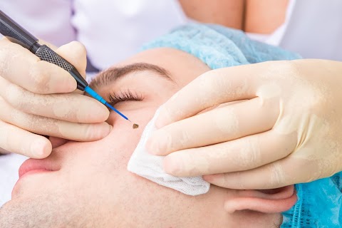 Mole Removal Menlo Park