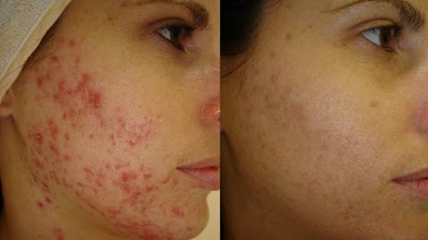 Pure Skin Electrolysis