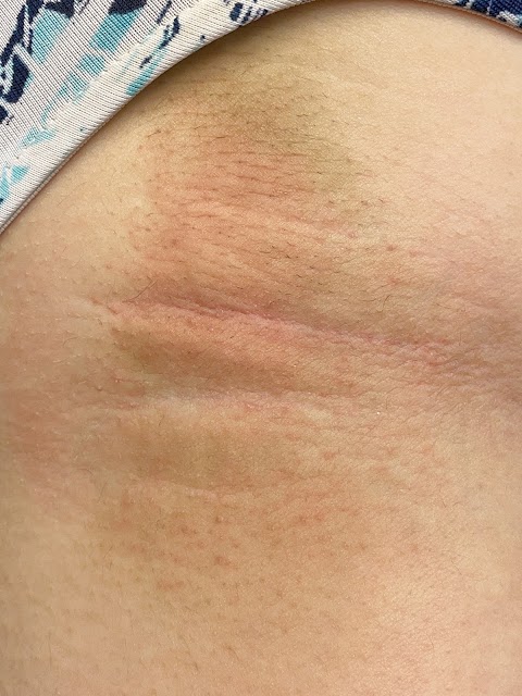 Electrolysis of Placer