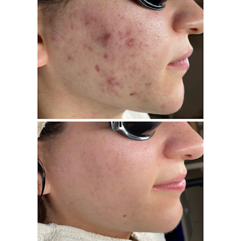 Acne Specialists of SoCal