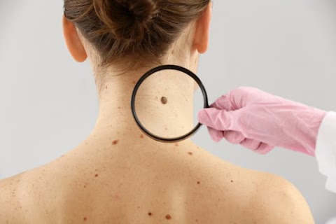 Mole Removal Los Angeles