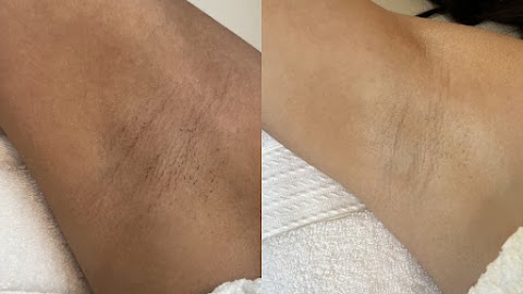 Body Bleaching.209