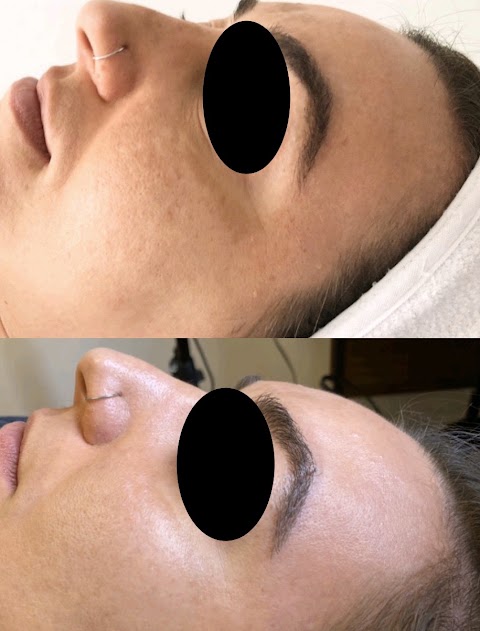Skin Peels -The Peel Connection - LA