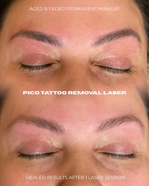 Undo Laser Tattoo Removal