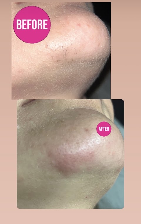 Zapped by Rose Electrolysis Hair Removal Canyon Lake, CA