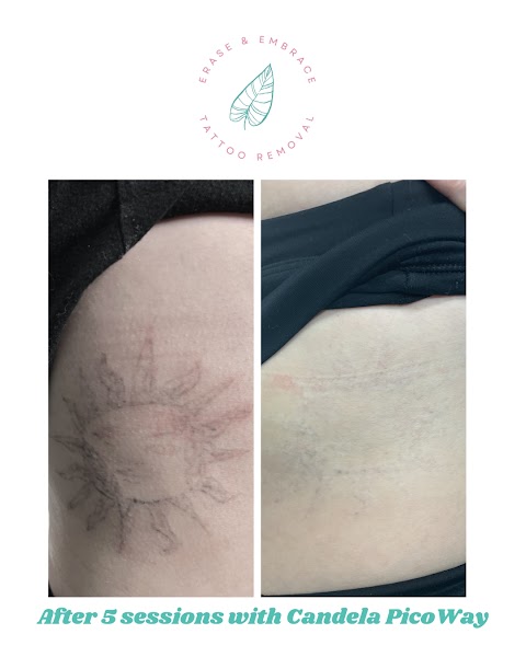 Erase & Embrace Tattoo Removal