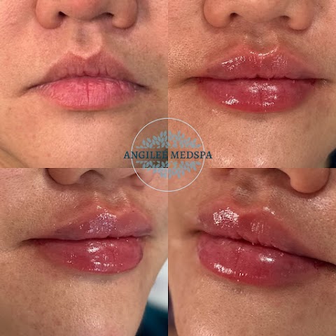 Angileé Med Spa