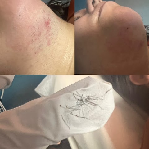 Bare Electrolysis Face & PCOS Specialists