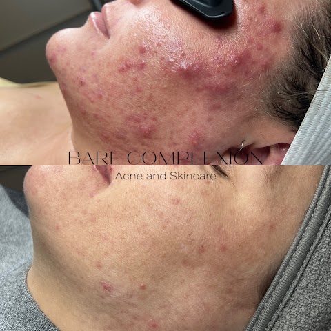 Bare Complexion Acne & Skincare