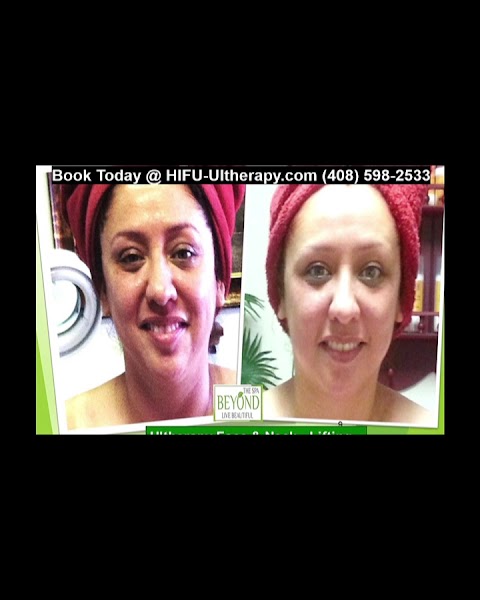 Beyond The Spa is #1 Specialized in HIFU-Ultherapy Trail: $499