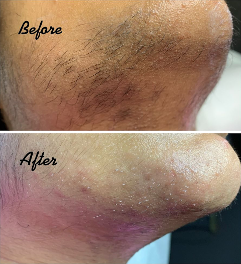 The Electrolysis Expert