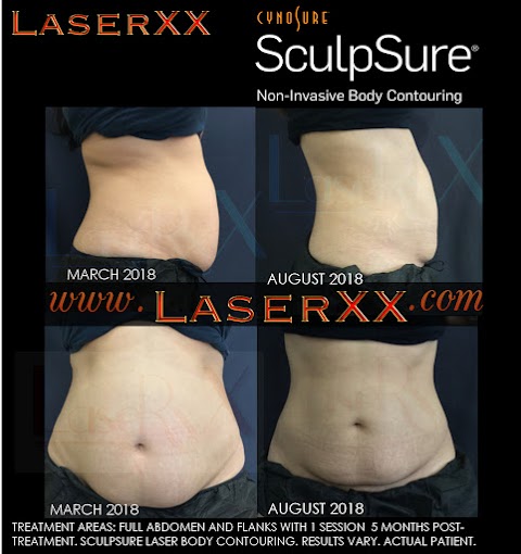 LaserXX