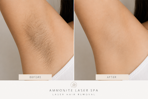 Ammonite laser Spa