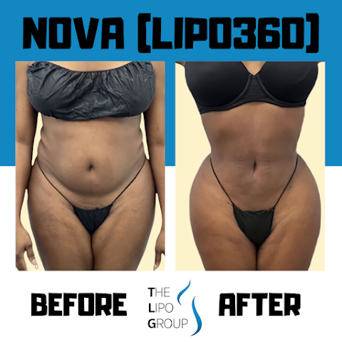 The Lipo Group: Liposuction NYC