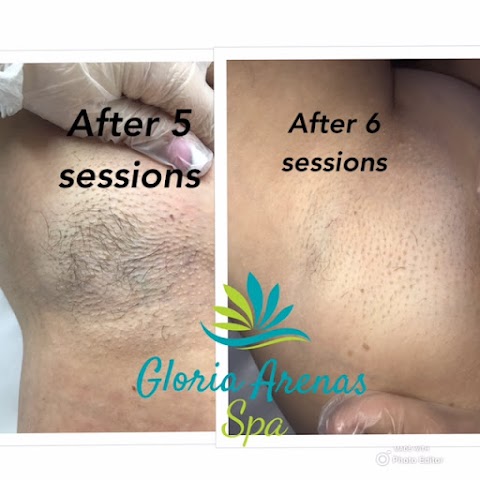Laser Hair Removal - Tattoo Removal