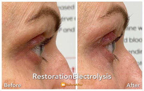 Restoration Electrolysis, LLC