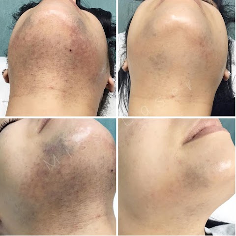 Miss Laser - Laser Hair Removal, Tattoo Removal & Body Contouring
