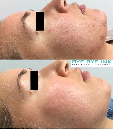 Bye Bye Ink Laser Tattoo Removal