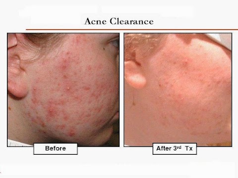 Medlaser