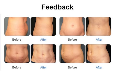 Bioskin Laser