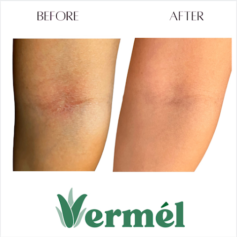 Vermel Skin & Laser Spa