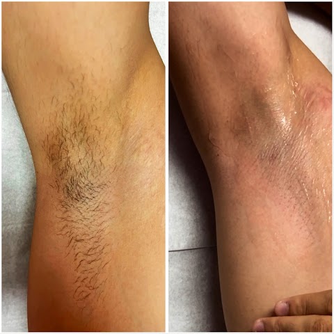 SA Beauty Lab Laser hair removal
