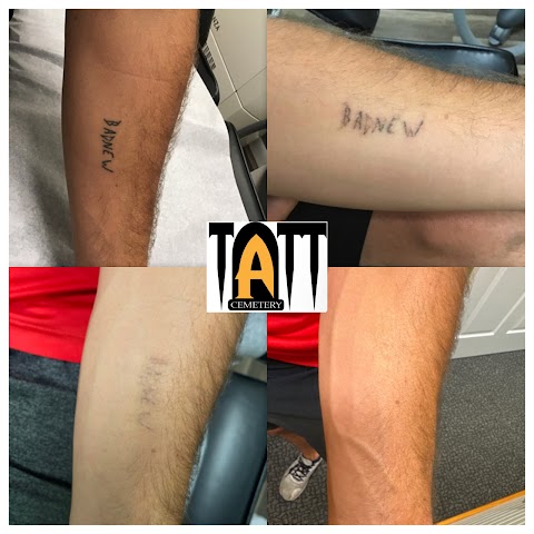 Laser Tattoo Removal by Tatt Cemetery