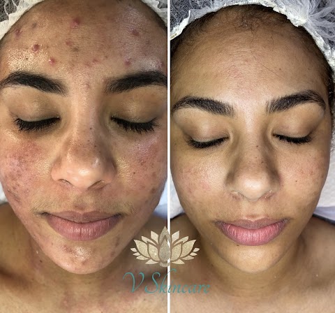 V Skincare | Acne, Dark Spots & Facial Specialist – Apopka FL