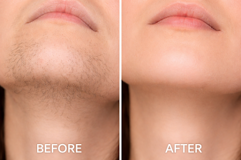 Bay Harbor Med Spa • Electrolysis, Laser Hair Removal.