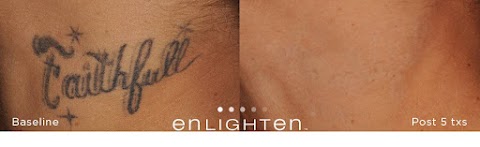 Miami Ink Off Tattoo Removal Clinic