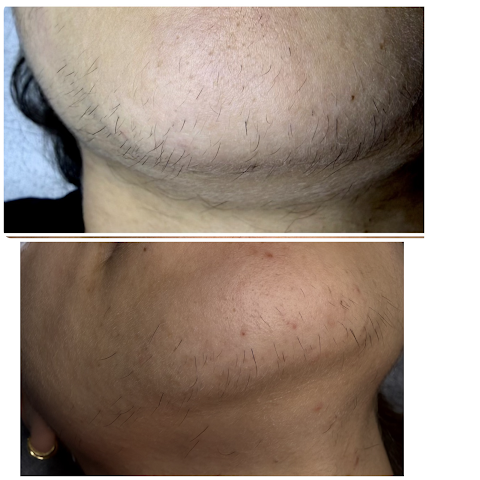 FLASH Electrolysis & Skin Care