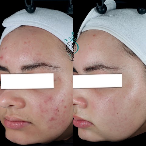 Facecare Acne Solutions