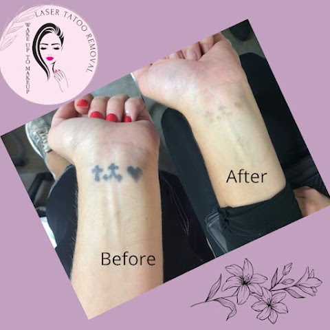 Laser Tattoo Removal Services