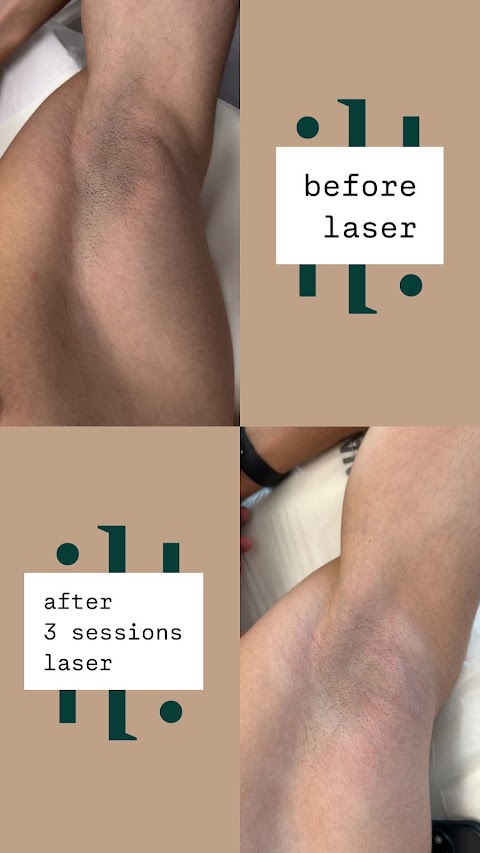 Silience - Laser & Electrolysis