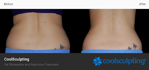 Elias CoolSculpting Center