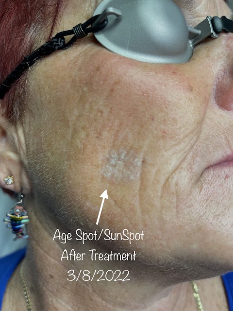 Envision Laser Removal