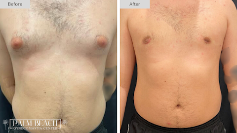 Palm Beach Gynecomastia Center - Port St. Lucie