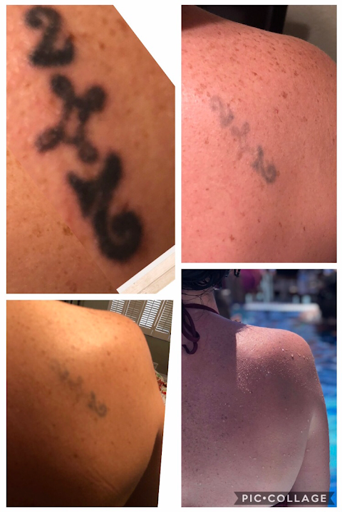 St Pete Tattoo Removal