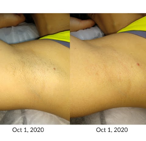 Electric Beauty electrolysis