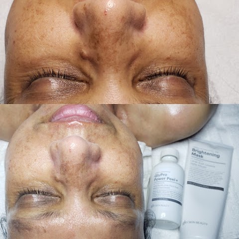 Facial Creations Spa of Tampa Bay. #1 Acne and Microdermabrasion center
