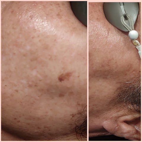 Miss Cassie's laser tattoo removal