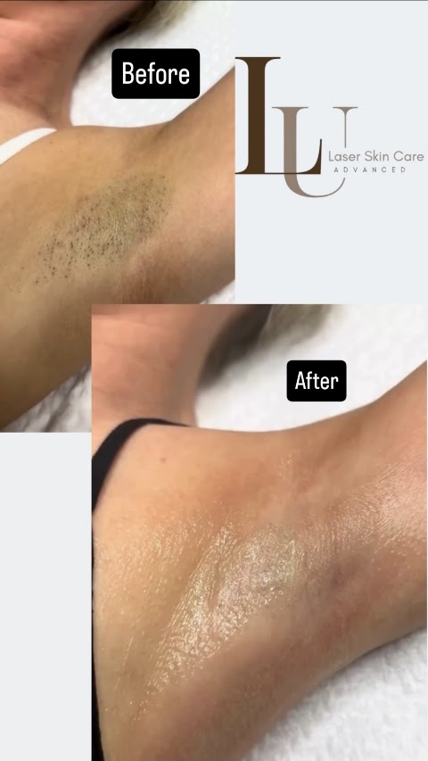 LU Laser Skin Care Advanced
