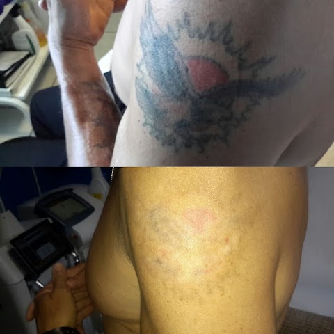 Winter Park Tattoo Removal